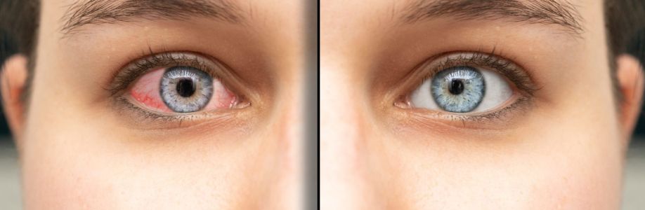 Conjunctivitis Therapeutics Market to Experience Significant Growth by 2033 Cover Image