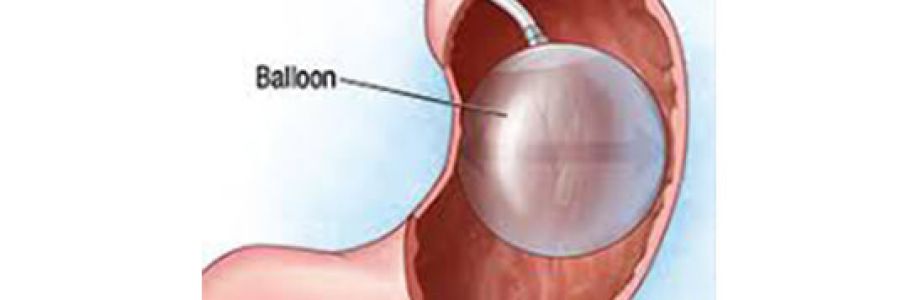 Global Non-surgical Intragastric Balloon Market will reach at a CAGR of 9.80% from 2022 to 2030 Cover Image