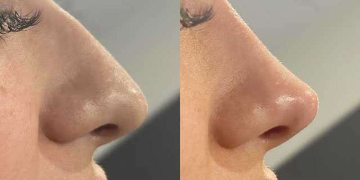 Non-Surgical Rhinoplasty in Dubai - Enhance Your Nose with Non-Invasive Techniques!