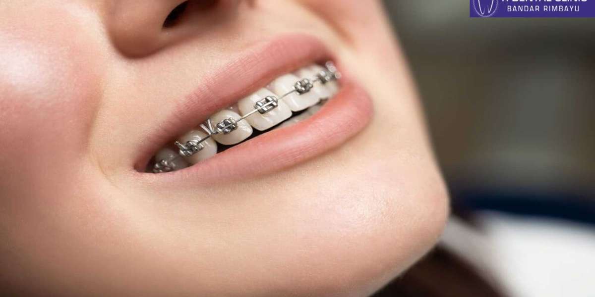 Braces for Kids: Navigating the Journey to Healthy Teeth (Tidental)