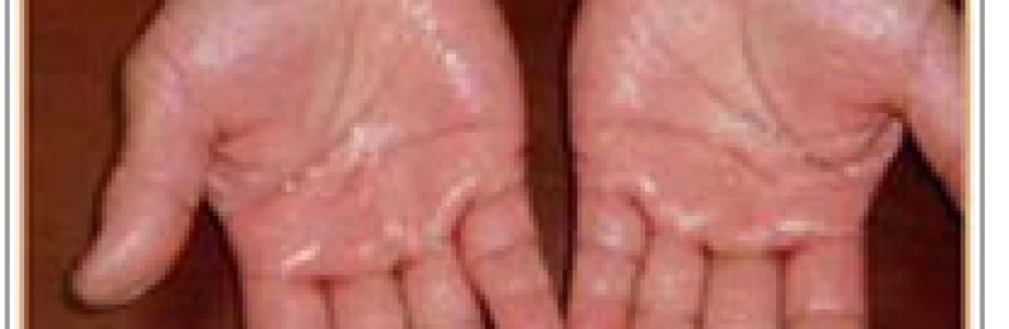 Palmer Hyperhidrosis Treatment Market To Witness Huge Growth By 2033 Cover Image