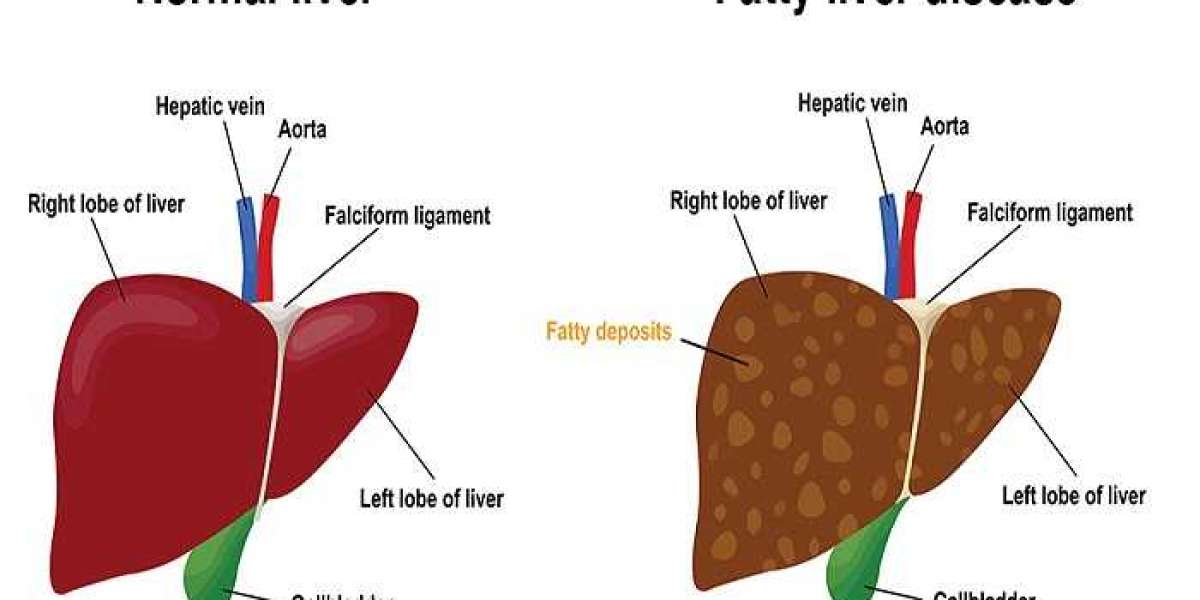 What are the symptoms of a fatty liver getting worse?